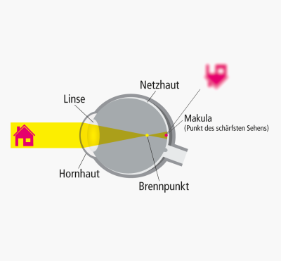 Ursachen: Wie entsteht Kurzsichtigkeit (Myopie)?