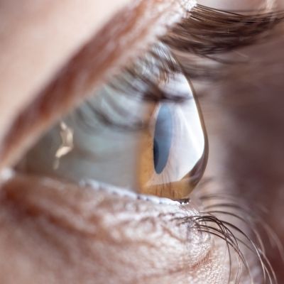 Medizinische Kontaktlinsen korrigieren irreguläre Hornhäute Medizinische Kontaktlinsen korrigieren irreguläre Hornhäute