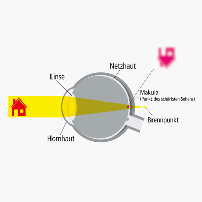 Ursachen: Wie entsteht Weitsichtigkeit (Hyperopie)?