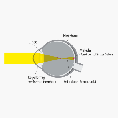 Ursachen für Keratokonus (Hornhautkegel)