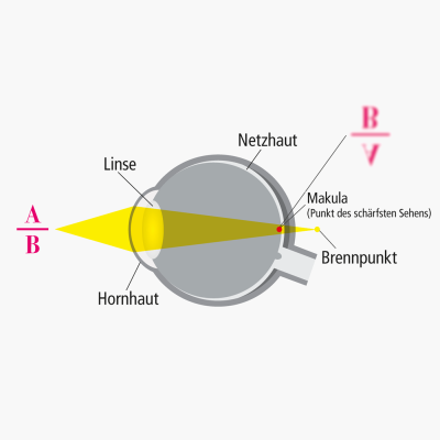 Ursachen: Wie entsteht Alterssichtigkeit (Presbyopie)?