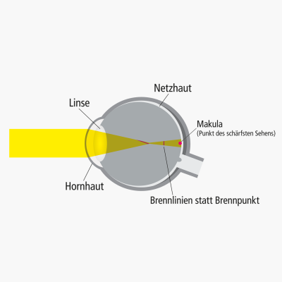 Ursachen für Hornhautverkrümmung (Astigmatismus)